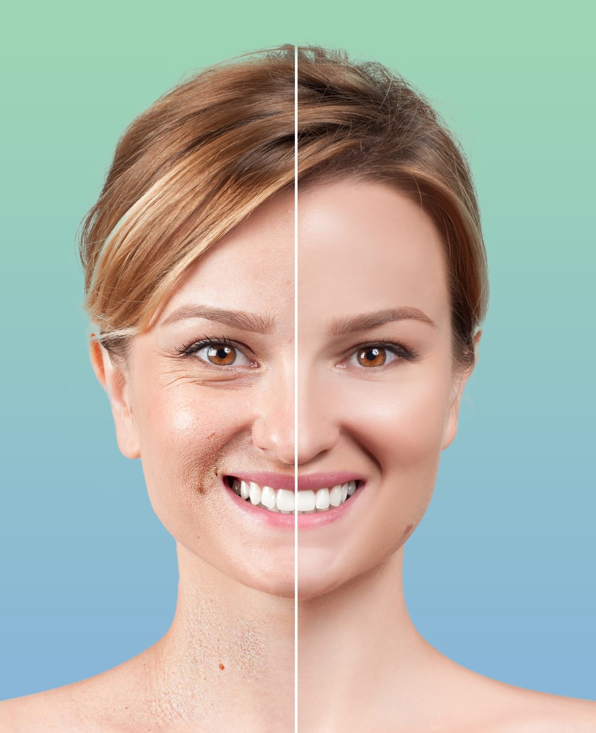 Results and Benefits of Morpheus8 Treatment