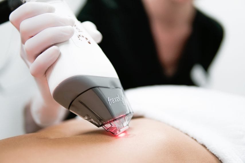 Fraxel Treatment