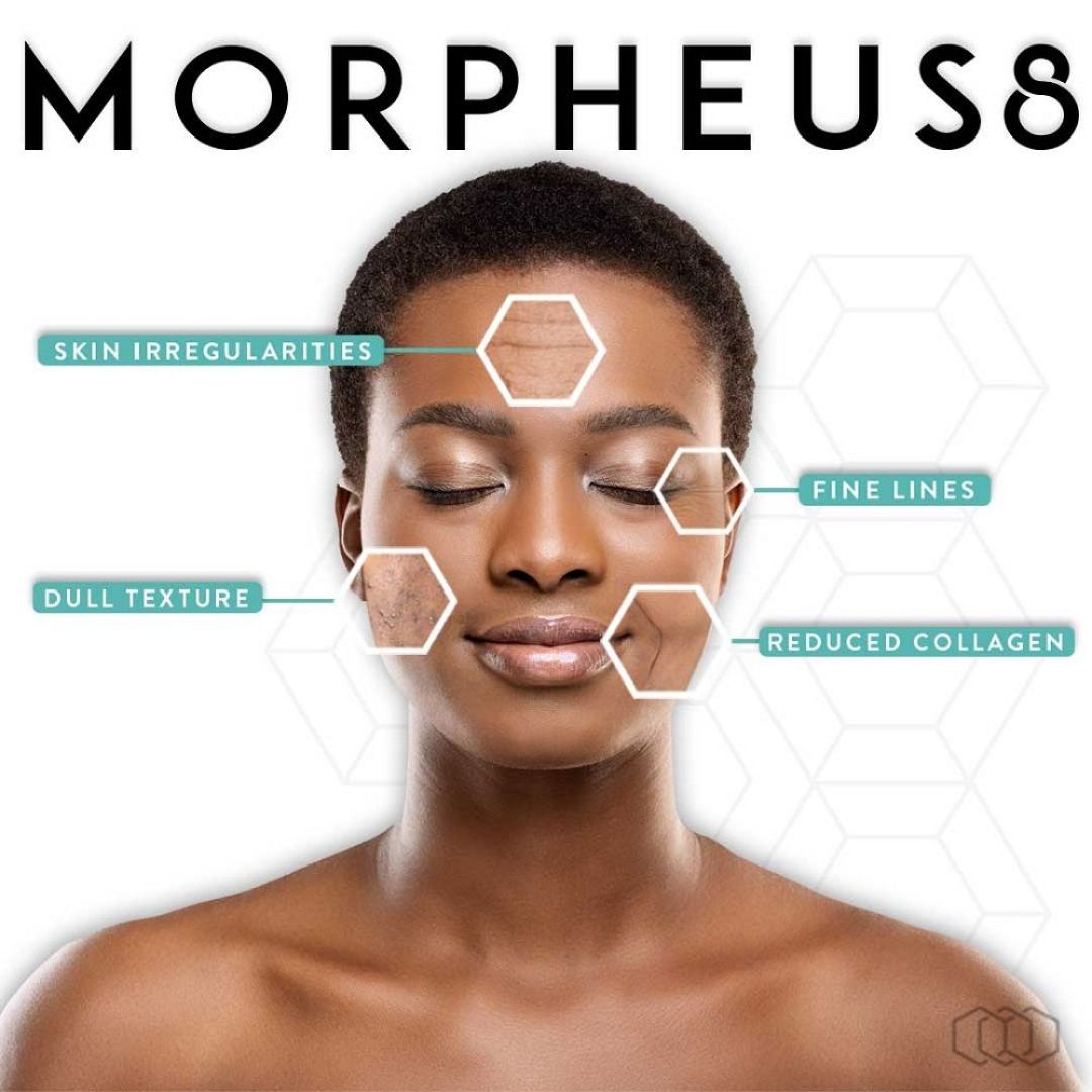 RF Microneedling with Morpheus8