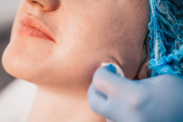Morpheus8 for Neck & Jawline Tightening