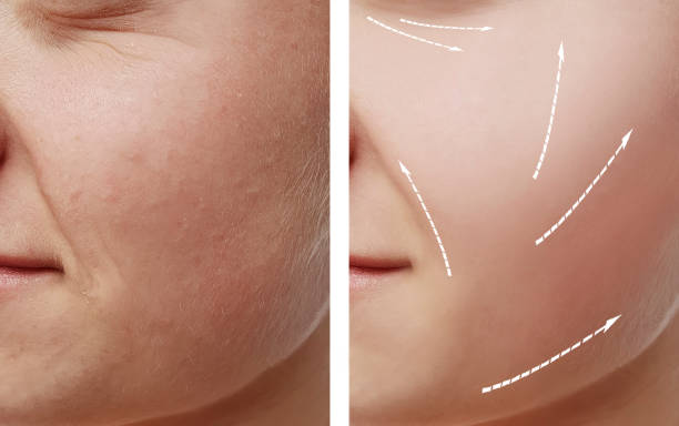 Fraxel vs. Chemical Peels vs. Microneedling