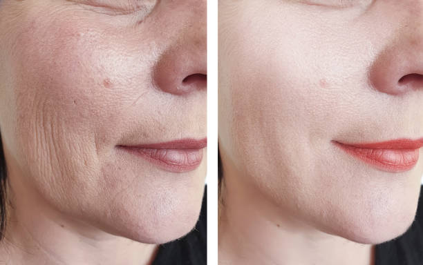 Morpheus8 Microneedling