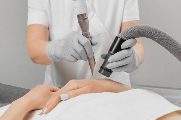 Laser Treatments