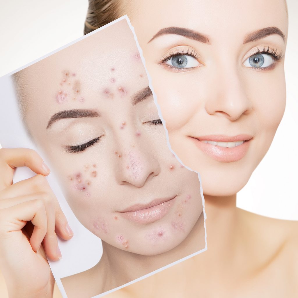 Laser ‘n’ Beyond | How Laser Therapy Helps Treat Acne Scars & Hyperpigmentation