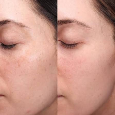 Laser ‘n’ Beyond | How Laser Therapy Helps Treat Acne Scars & Hyperpigmentation Laser therapy